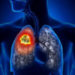 tumore-al-polmone-2-1000x700-1