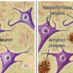 15060-2-figura-2-a-destra-illustrazione-delle-placche-senili-e-ammassi-neurofibrillari-che-circondano-i-neuroni-nel-cervello-con-alzheimer