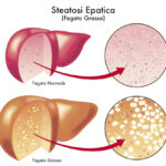 1steatosi_epatica_opt-1