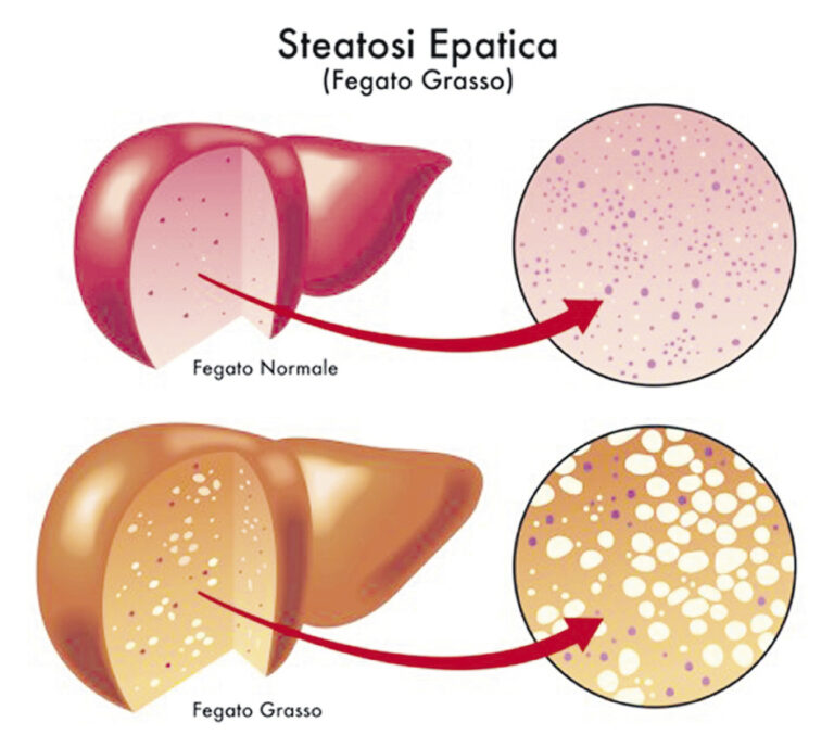 Steatosi epatica le cellule immunitarie la promuovono MediMagazine