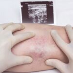 coagulazione_thumb_720_480