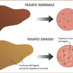 fegato-grasso-diabete