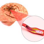 ictus