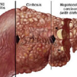 liver-diseases