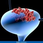 content_carcinoma-vescica