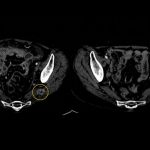 newly-approved-drug-ef