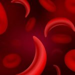 sickle-cell-877x470 (1)
