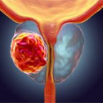 181204-sopravvivenza-tumore-prostata