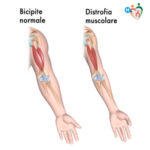 content_distrofiamuscolare