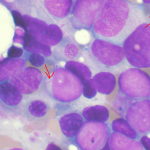 myeloidleuke (1)