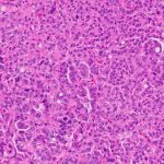 Histological-Staining-of-a-Lung-Adenocarcinoma-777x505