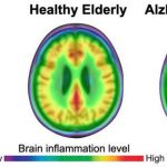 brain-tissue-inflammat