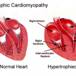 cardiomiopatia-ipertrofica_1