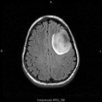 oligodendroglioma_low_grade_high_it