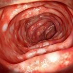 Colon-With-Ulcerative-Colitis-777x583