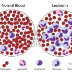 Leukemia