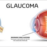 glaucoma (1)