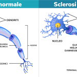 malattia-sclerosi-multipla-patologia-dal-decorso-cronico-02