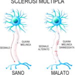 medicina-online-sclerosi-multipla-neurone-guaina-mielinica-sistema-nervoso