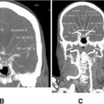 new-screening-tool-ide
