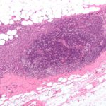 6-breastcancer