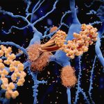 Amyloid-Protein-Clumps-Along-Neurons