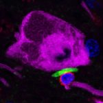 lewy-body-dementia-exa