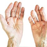 artrite-reumatoide-blog