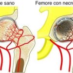 avascular-necrosis-hip-1