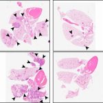 by-putting-cancer-cell