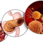 Pancreas Cancer Anatomy