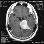 xmeningioma-preop.jpg.pagespeed.ic.jflT2cdDrs
