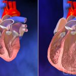 3850378299001_4818688185001_098-CongestiveHeartFailure