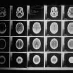 brain-tumor-1