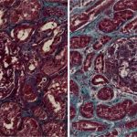 kidney-damage-as-a-res