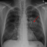lungcancer