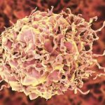 tumore-colon-retto-1