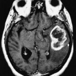 AFIP-00405558-Glioblastoma-Radiology (1)