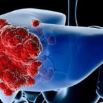 CANCRO-AL-FEGATO-COPERTINA-Copia