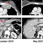 Breast-Cancer-Before-and-After-Immunotherapy-777x512