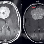 meningioma