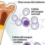 mieloma2-kjZ-RVE5G6UJi4LzNyUlgcYBScK-656x492@Corriere-Web-Sezioni