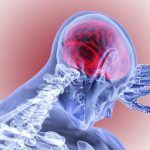 Brain-Bleeding-Stroke-Hemorrhage-777x518