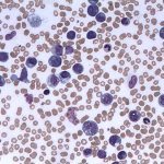 Chronic_Myelomonocytic_Leukaemia_(CMML)