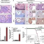 cause-of-metastasis-in