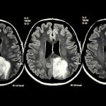 glioblastoma-2