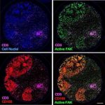 how-ovarian-cancer-def