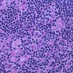 lymphoma