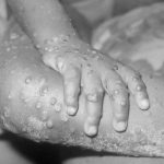 _103585163_monkeypox-getty