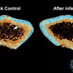 sars-cov-2-infection-i